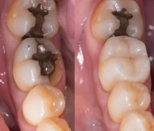 Temporary Tooth Filling replacement Temporary Tooth Filling replacement