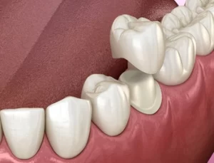 Cheap Dental Crowns type Cheap Dental Crowns type