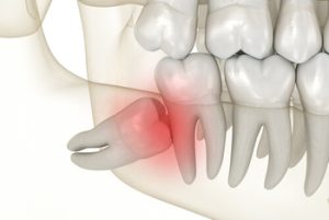 Does Wisdom Teeth Removal Hurt impacted Does Wisdom Teeth Removal Hurt impacted