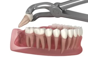 What Does Wisdom Teeth Pain Feel Like extraction What Does Wisdom Teeth Pain Feel Like extraction