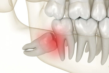 wisdom tooth pain impacted wisdom tooth pain impacted