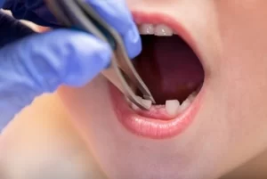 Tooth Extraction White Stuff Fell Out No Pain abcess Tooth Extraction White Stuff Fell Out No Pain abcess