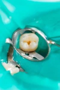 Tooth Extraction White Stuff Fell Out No Pain procedure Tooth Extraction White Stuff Fell Out No Pain procedure