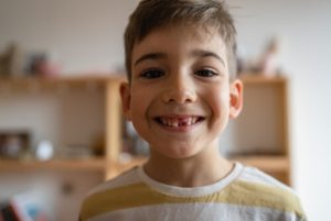 Tooth Extraction White Stuff Fell Out No Pain removal Tooth Extraction White Stuff Fell Out No Pain removal