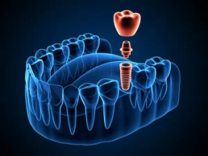 3D illustration of a dental implant, abutment, and crown in a jawbone cross section. 3D illustration of a dental implant, abutment, and crown in a jawbone cross section.