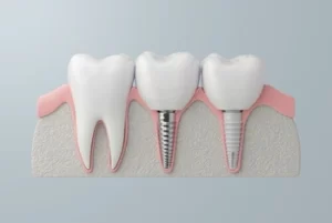 how to relieve pain from dental implant procedure how to relieve pain from dental implant procedure