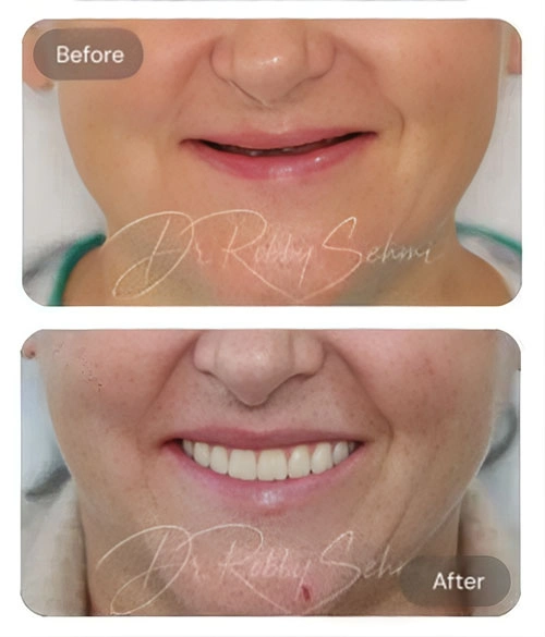Finesse Case Before After Result A