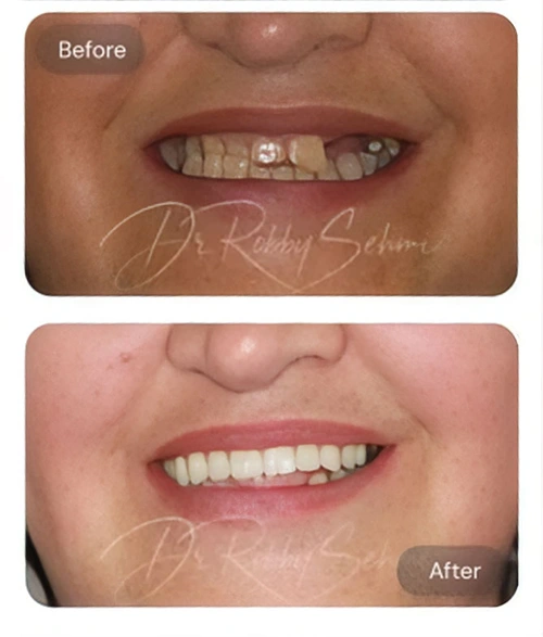 Finesse Case Before After Result B
