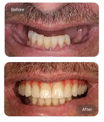 Finesse Case Result Before After C