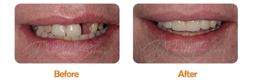 Bridge Before and After Case Result 1
