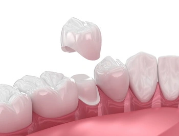 Broken Tooth Pain crown Illustration of a dental crown being placed over a tooth in a row of healthy teeth. The image shows the precision in dental restoration work.