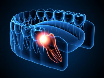 Broken Tooth Pain wisdom 3D X-ray of human teeth highlights an impacted wisdom tooth in red. The rest of the teeth are shown in translucent blue, illustrating dental health concerns