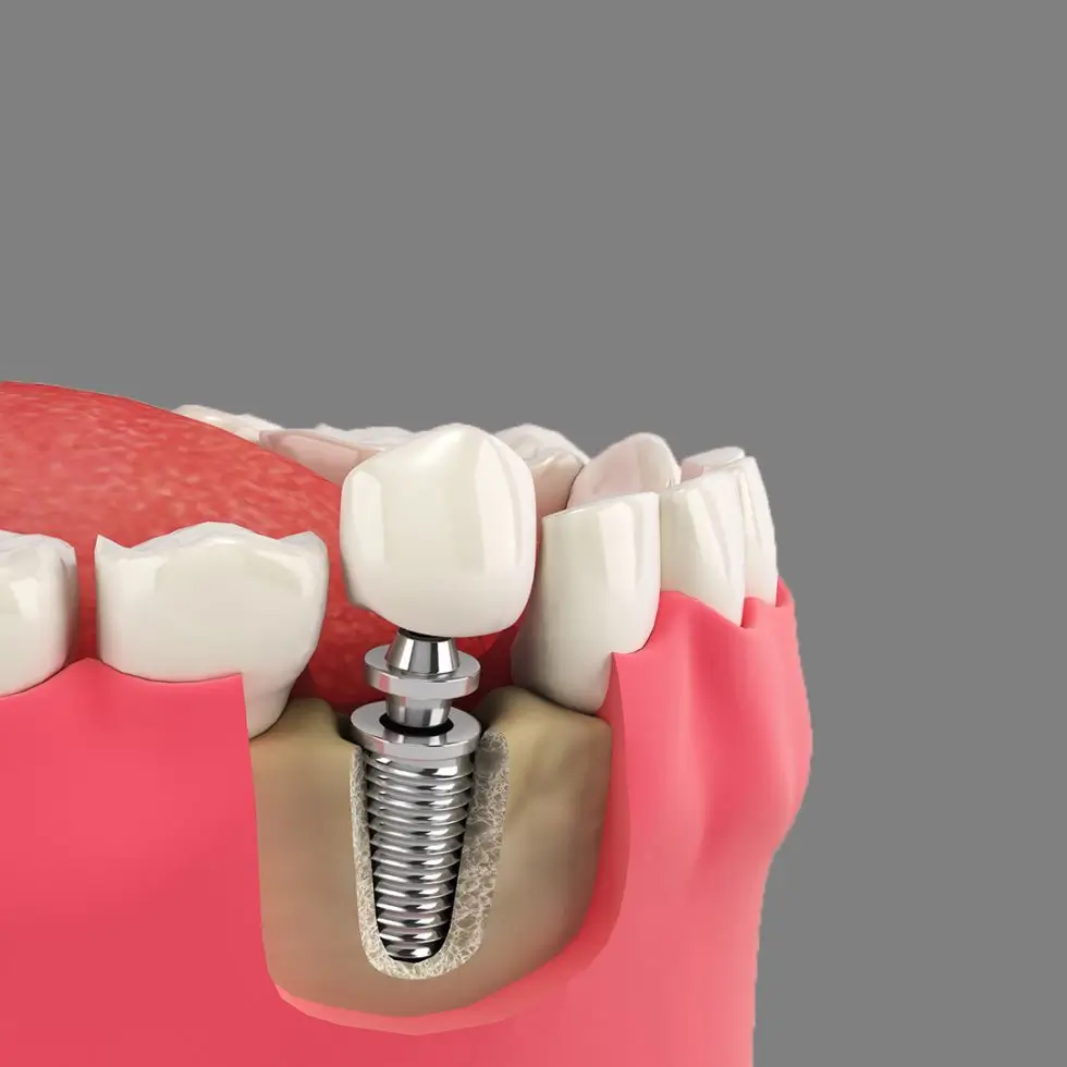 Illustration showing a dental implant with a metal screw anchored in the jawbone, supporting a crown