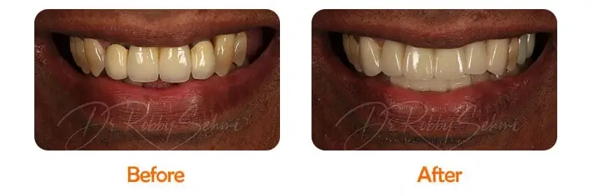 Finesse Dental Bridge Case 1