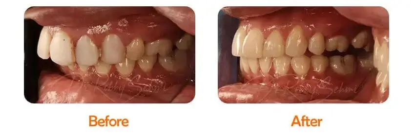 Finesse Dental Composite Veneers Case 1