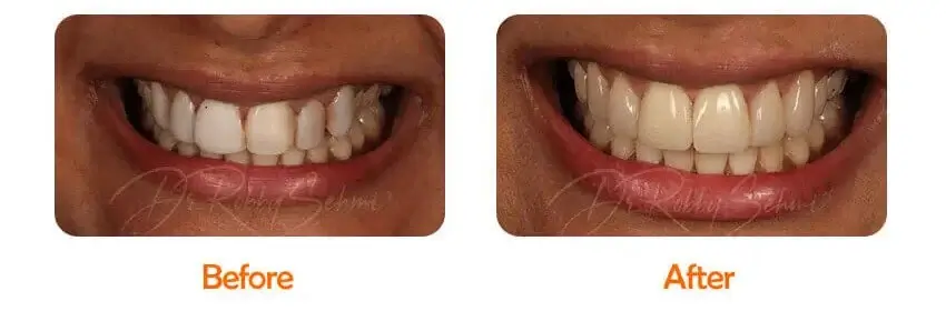 Finesse Dental Composite Veneers Case 2