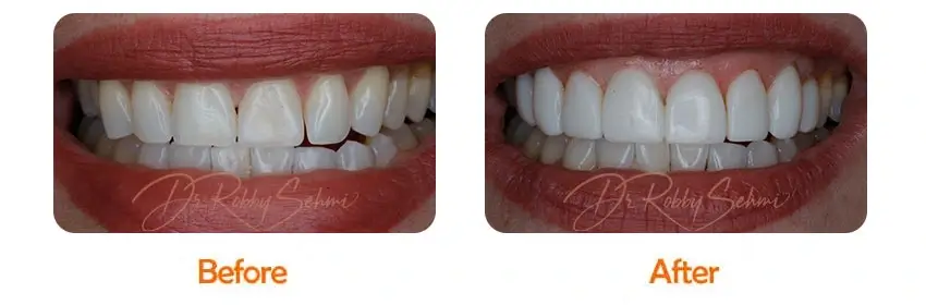 Finesse Dental Composite Veneers Case 3