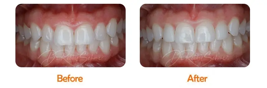 Finesse Dental Composite Veneers Case 4