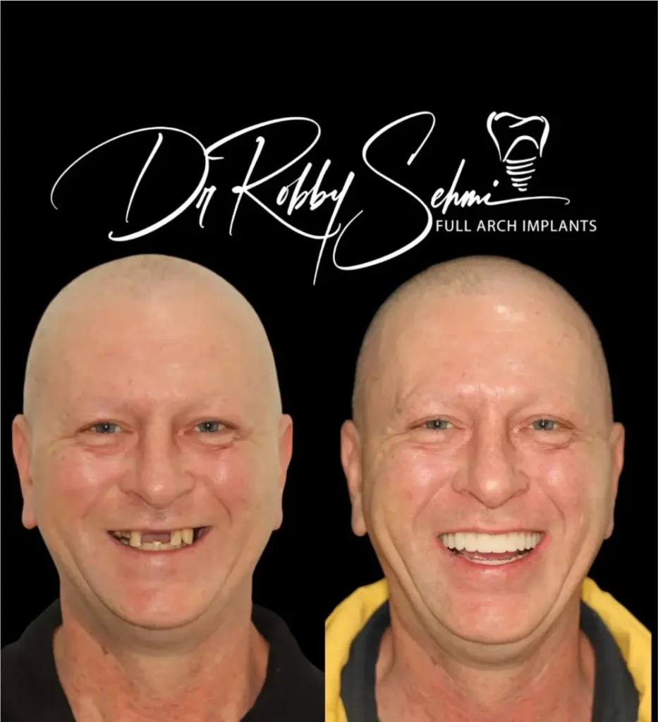 Finesse Dental Dental Implants Case 1
