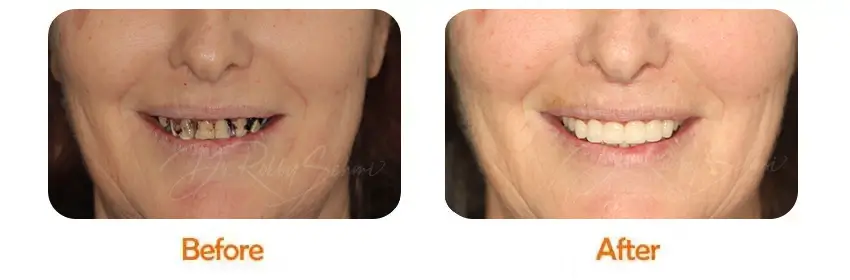 Finesse Dental Dental Implants Case 11
