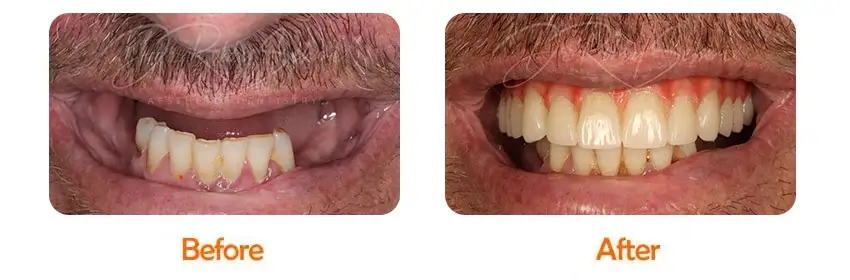 Finesse Dental Dental Implants Case 12