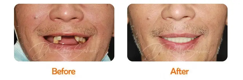 Finesse Dental Dental Implants Case 13