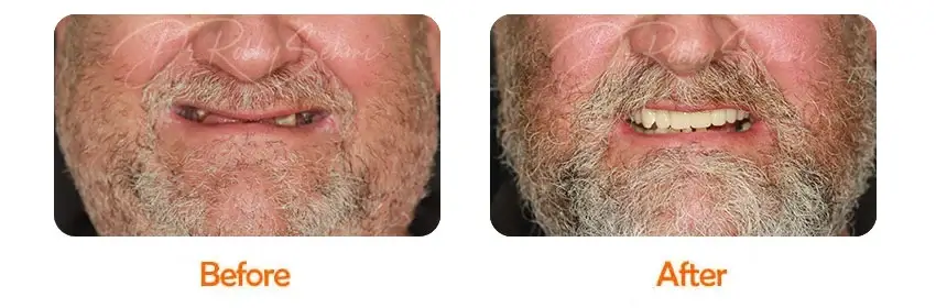 Finesse Dental Dental Implants Case 14