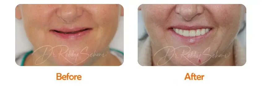 Finesse Dental Dental Implants Case 15