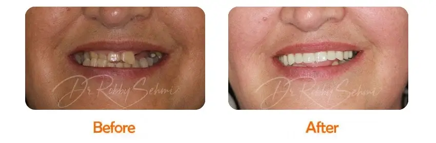 Finesse Dental Dental Implants Case 16