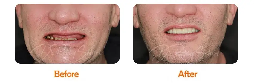 Finesse Dental Dental Implants Case 17