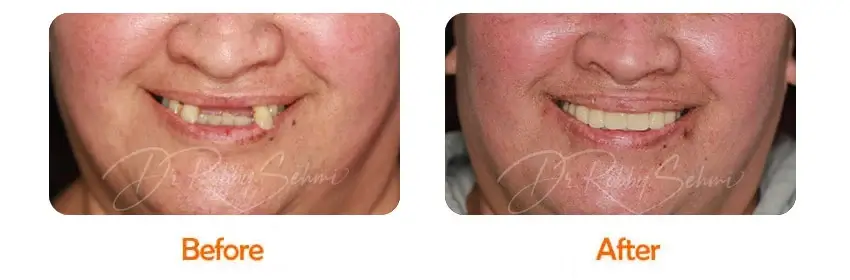 Finesse Dental Dental Implants Case 18