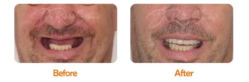 Finesse Dental Dental Implants Case 19
