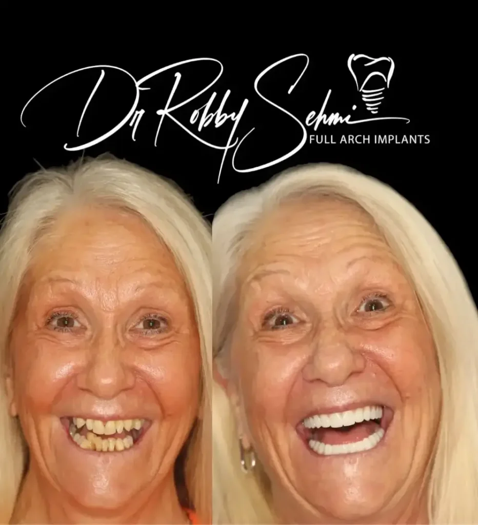 Finesse Dental Dental Implants Case 8