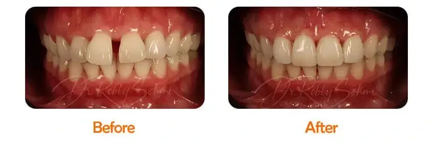 Finesse Dental Orthodontics Case 1