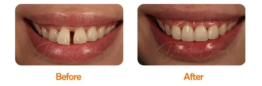 Finesse Dental Orthodontics Case 2