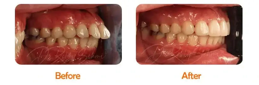 Finesse Dental Orthodontics Case 3
