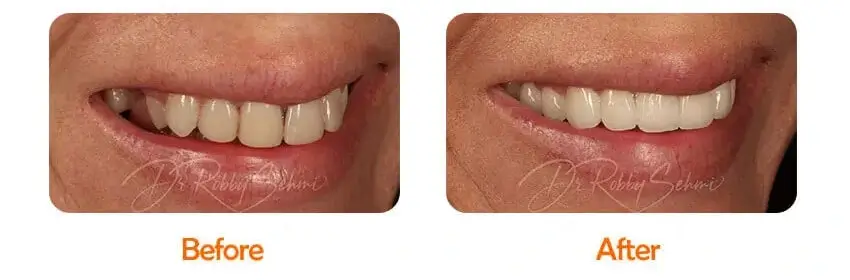 Finesse Dental Venners Case 1