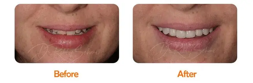 Finesse Dental Venners Case 2