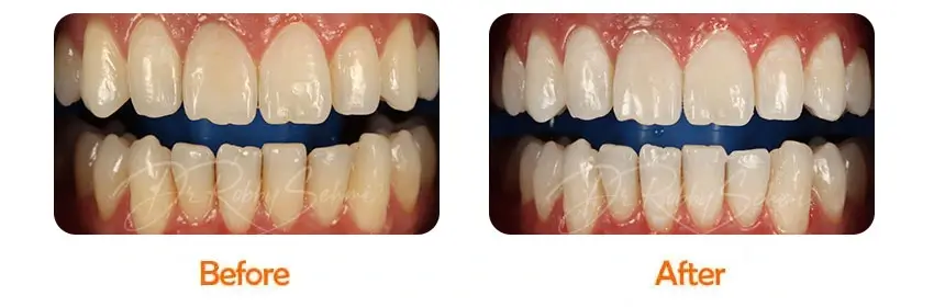 Finesse Dental Whitening Case 1