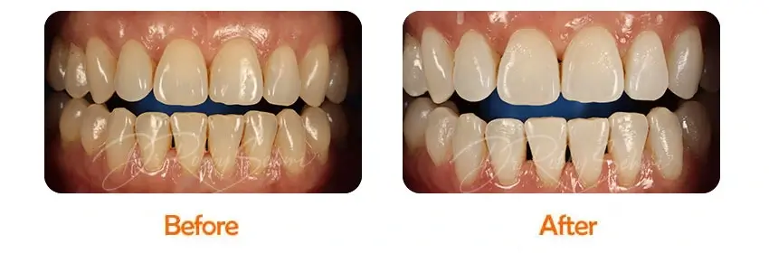 Finesse Dental Whitening Case 2