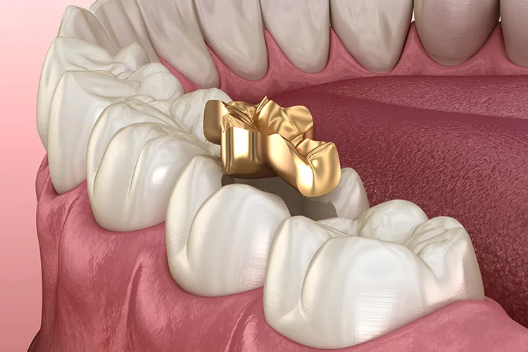 Illustration of a human mouth showing a gold dental crown on a molar emphasizing dental restoration