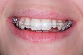 Close-up of a smiling mouth with pink lips wearing clear braces on teeth. The image conveys a sense of dental care and orthodontic treatment.