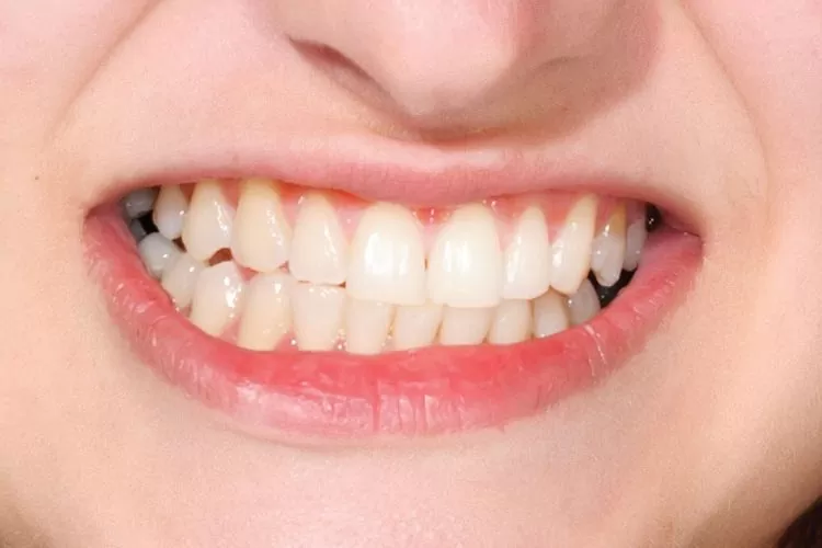 A close-up of a person clenching their teeth, demonstrating the signs of bruxism and teeth grinding which can be treated with custom dental night guards