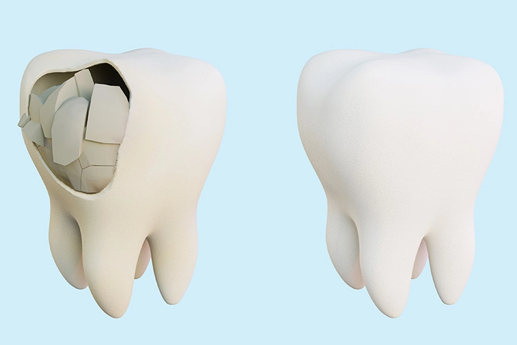 Two molar illustrations the left molar is cracked open while the right molar appears intact