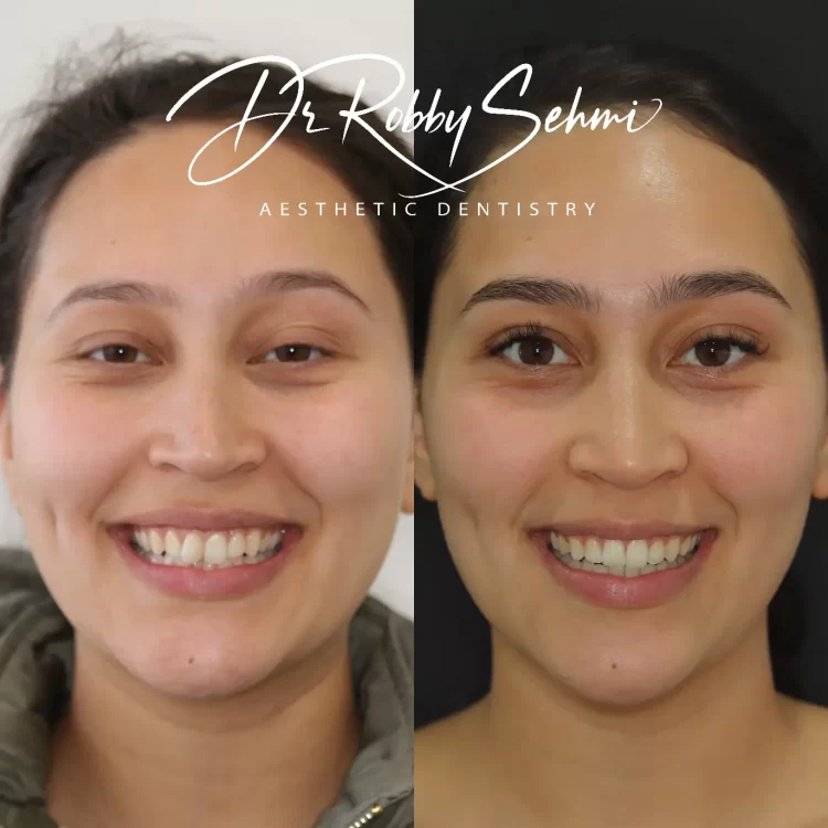 Anaher Cullen before after