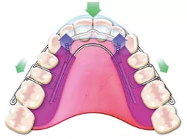 Dental appliance illustrate the arrows indicate arch expansion