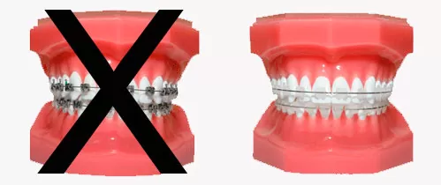 A dental model highlighting a comparison between braces and aligners.