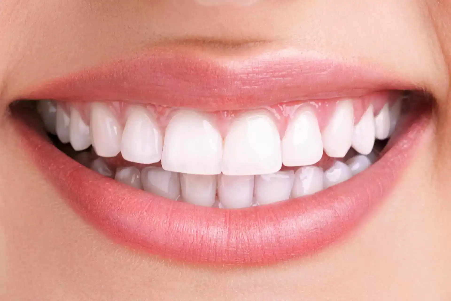 A close-up of a radiant, white smile after a professional teeth whitening treatment, showcasing the bright and stain-free results achieved through clinical whitening.