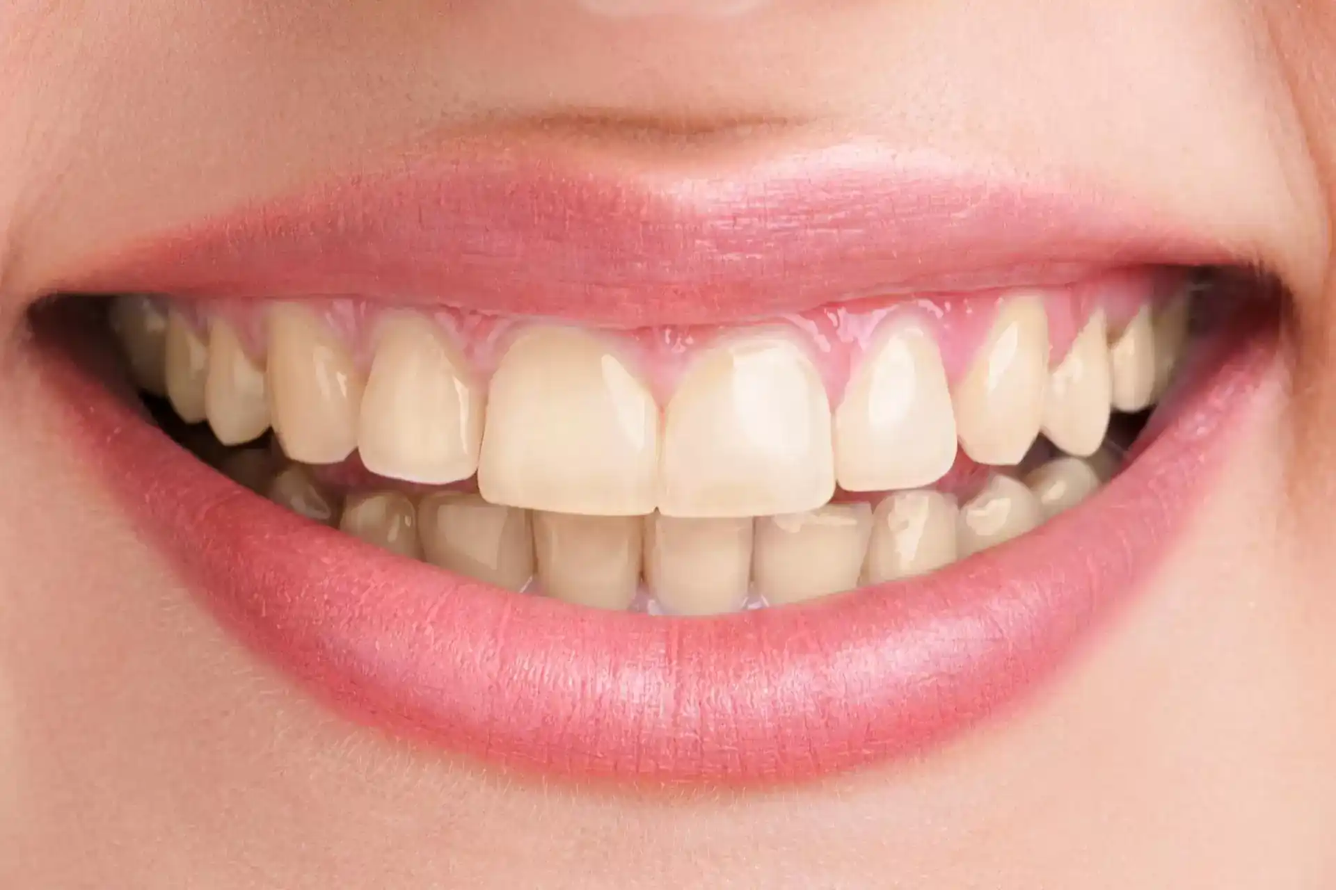 teeth whitening before A close-up of a person’s smile before a professional teeth whitening treatment, showing natural tooth discoloration and stains ready for whitening