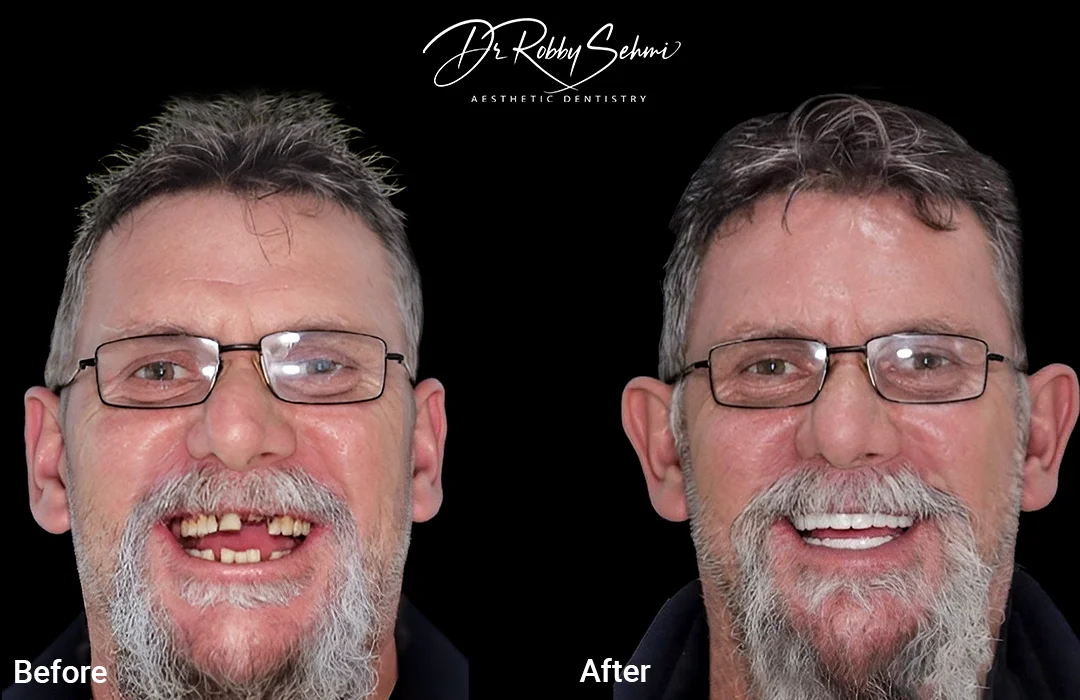 Dental Implants - Before After - Case 2